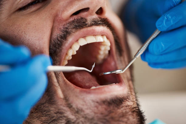 Best Knocked-Out Tooth (Avulsed Tooth) Treatment in Valley Falls, RI