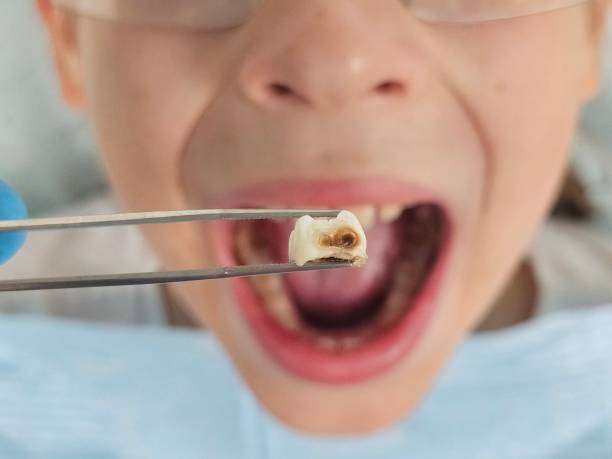Best Dental Abscess Treatment in Valley Falls, RI